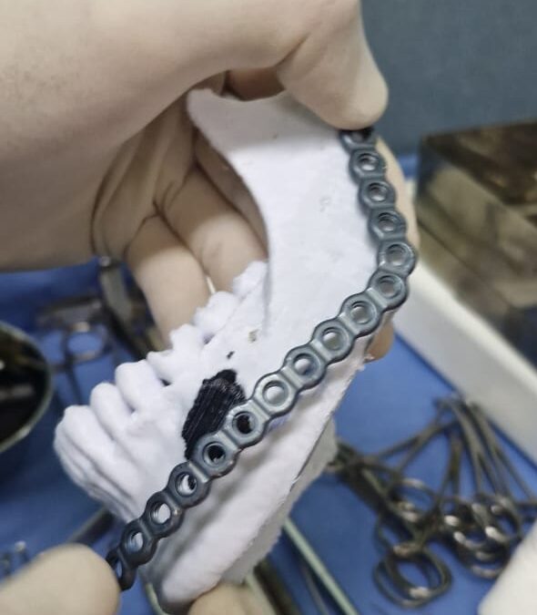 EL HOSPITAL MUNICIPAL A LA VANGUARDIA: LAS CIRUGÍAS PLANIFICADAS CON IMPRESIONES 3D YA SUPERAN LAS 60 INTERVENCIONES